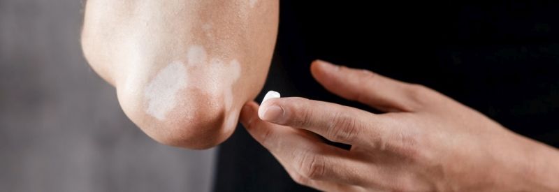 Opzelura (Ruxolitinib Cream) for Vitiligo: The Complete Patient Guide