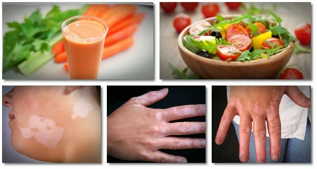 Vitiligo Home Remedies: What Has Evidence, What Is Safe, and What to Skip