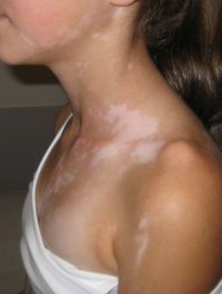 What Is Segmental Vitiligo And What Can You Do About It?