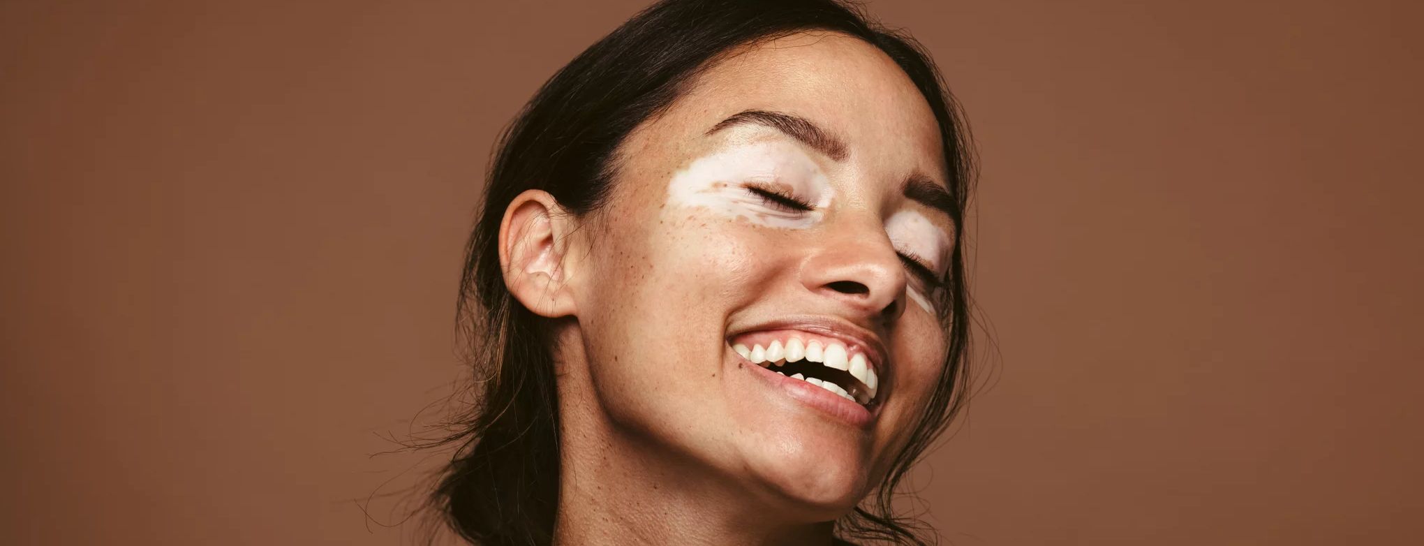 How to treat Vitiligo around eyes