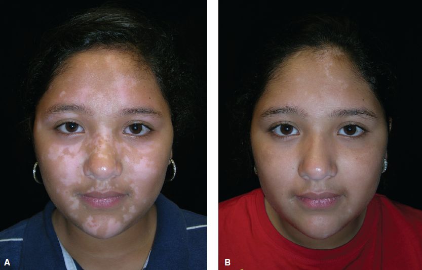 Vitiligo in Children: A Parent's Guide to Treatment, School, and Emotional Impact