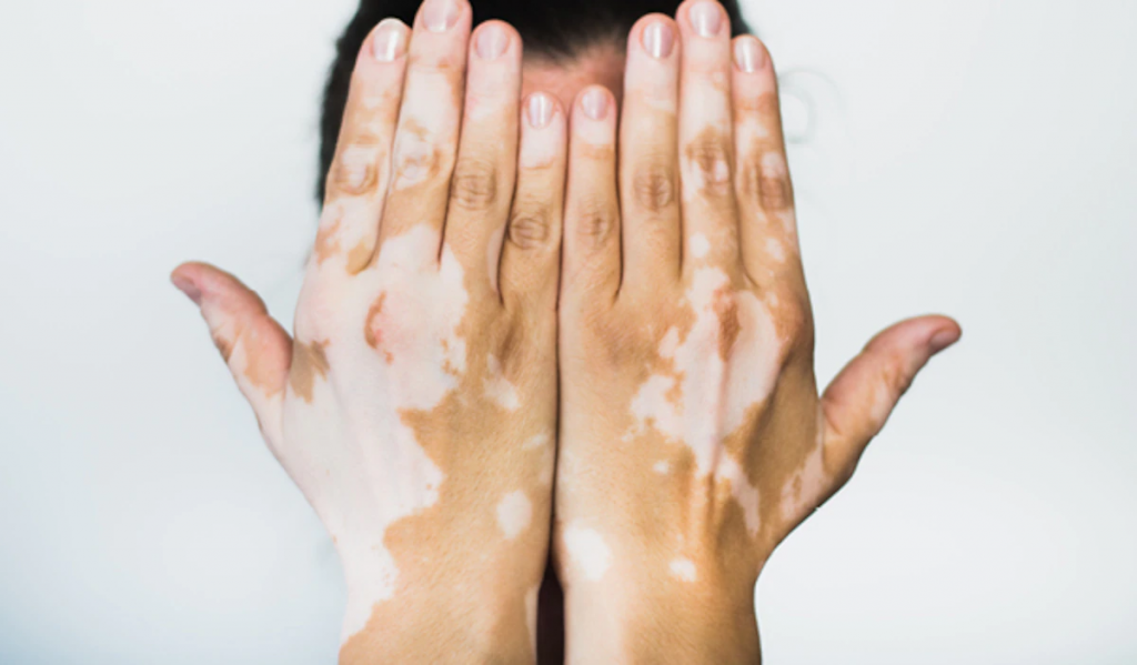 skin discoloration and treatment