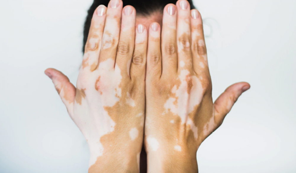 Causes of Skin Discoloration and How to Treat Them