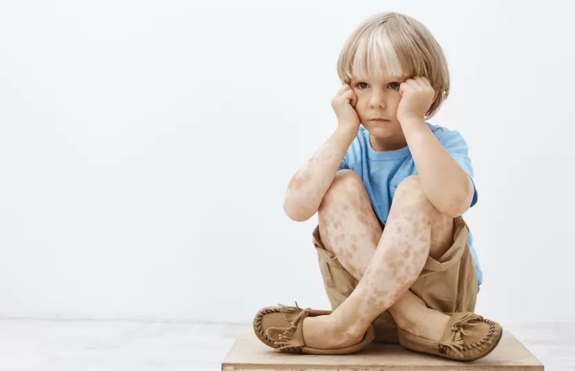 Calcipotriol for Vitiligo in Children: Evidence, Dosing, and What Parents Should Ask